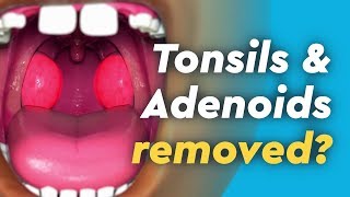 Tonsil Stone Removal  Popping Tonsil Stones [upl. by Underwood584]