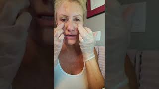 Getting better at Meso Mesotherapy with Miracle L  PCL DIY Facial [upl. by Beniamino264]