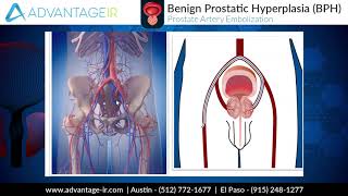 Prostate Artery Embolization PAE Explained [upl. by Adlei701]