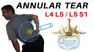 Annular Tear L4L5 L5S1 Disc Bulges [upl. by Dal]