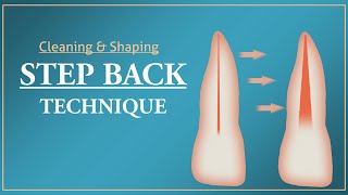 Step Back Technique  Root Canal Treatment [upl. by Herv]