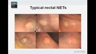 Negative for intraepithelial lesion or malignancy Nilm [upl. by Pool818]