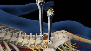 Lumbar Fusion of L5 S1 Animation [upl. by Reeve]