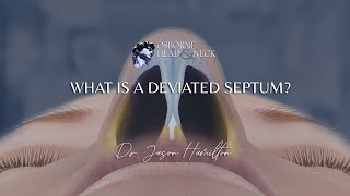 What is a deviated septum [upl. by Kynthia]