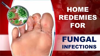 How to Cure Fungal Infection Using Home Remedies [upl. by Jehiel413]