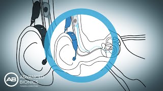 How Do Cochlear Implants Work  MEDEL [upl. by Lagasse]