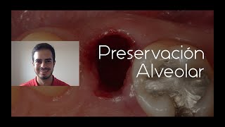 Preservación Alveolar  Dr Edwin Ruales Carrera [upl. by Tiffany890]