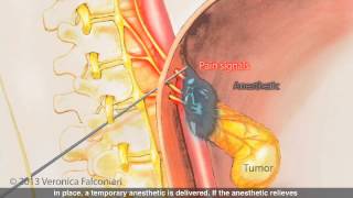 Supraclavicular Brachial Plexus Block [upl. by Pitarys]