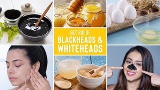 Easy Ways To Remove Blackheads And Whiteheads At Home [upl. by Dolley]