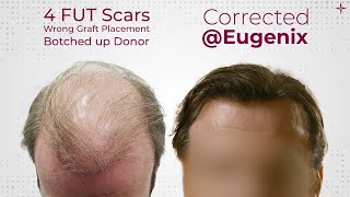 The Ultimate Hair Transplant Challenge A Challenging Hair Restoration Result achieved [upl. by Nerissa]