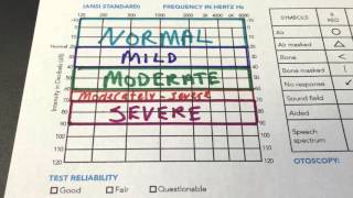 How to Read Your Audiogram [upl. by Nuhsal]