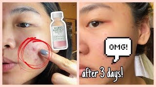 Mario Badescu Drying Lotion REVIEW 3 days result [upl. by Aytac63]