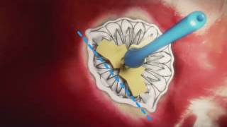 Cardiac Catheter Ablation What to Expect [upl. by Jochbed]