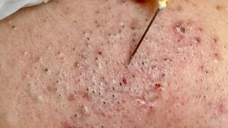 🔥 Pimple Popping 2020 Video Blackheads extraction Blackheads removal Acne removalAcne treatment [upl. by Orelle]