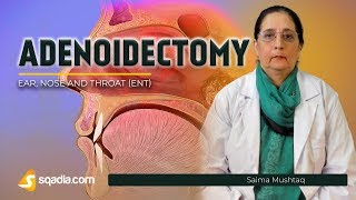 Save Your Child From Adenoid Surgery with Homeopathic Medicines [upl. by Dlonra]