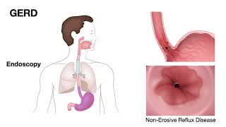 HOW to CURE GASTRITIS without medications  DR CARLOS [upl. by Nosaj]