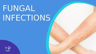 Fungal Infections  Causes Prevention and Cure [upl. by Anegue550]