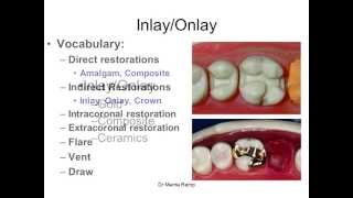 Introduction to inlaysonlays [upl. by Gilleod770]