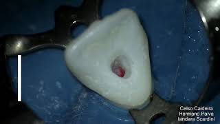 Endodontia Cirurgia de acesso Incisivo Central Superior [upl. by Worl624]