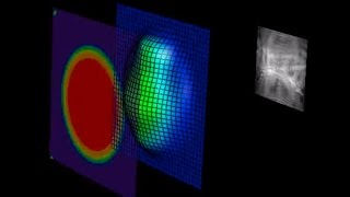 Real Question Longterm Risks for Lasik Surgery [upl. by Garvin]