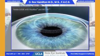 LASIK Surgery and its Risks [upl. by Ahsenrat]