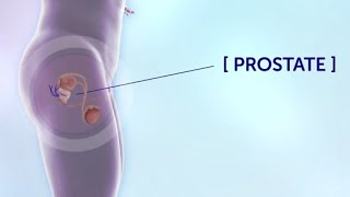 Treatment of Bone Metastases in Prostate Cancer [upl. by Anileve175]