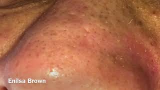 Blackheads Extractions and Acne Treatment on Daryl [upl. by Obeded506]