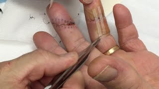 Hand Lac Suture Removal by Dr Gonzo More Houston Rain [upl. by Odrarebe]