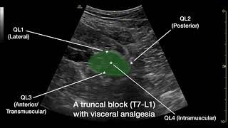 The Anterior Quadratus Lumborum QL Block [upl. by Aneehsal]